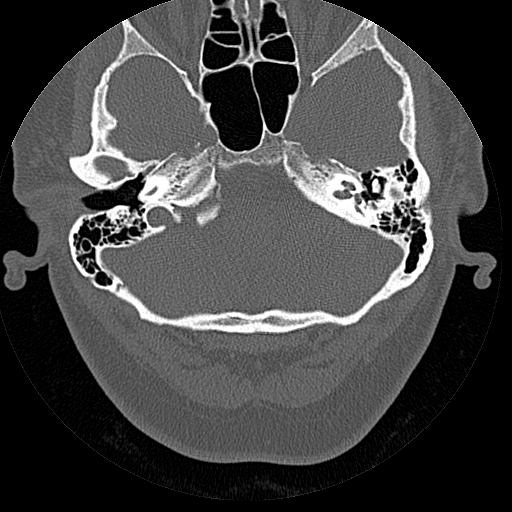 File:Bilateral ossifications of the external auditory canal (Radiopaedia 15233-15076 Axial bone window 9).jpg
