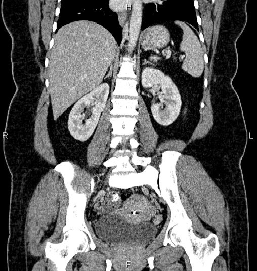 Bilateral ovarian dermoid cysts (Radiopaedia 85785-101603 C 36).jpg