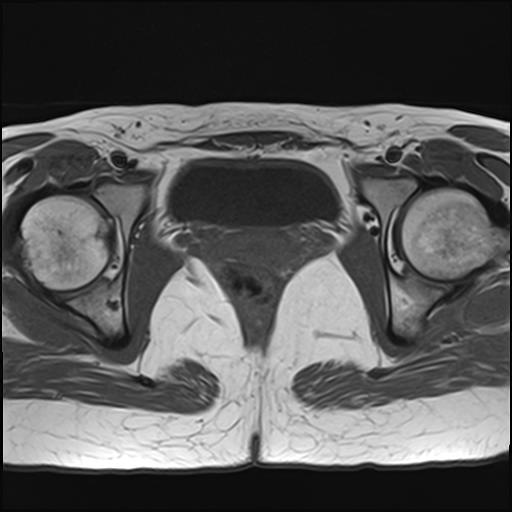 File:Bilateral ovarian endometriomas (Radiopaedia 87085-103347 Axial T1 17).jpg