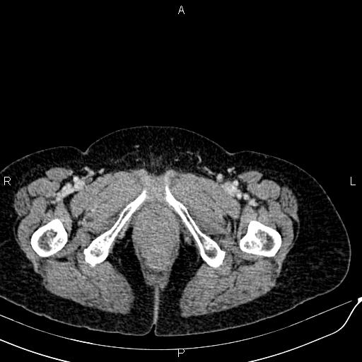 Bilateral ovarian serous cystadenocarcinoma (Radiopaedia 86062-101989 B 108).jpg