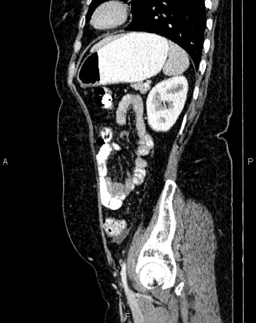 Bilateral ovarian serous cystadenocarcinoma (Radiopaedia 86062-101989 E 66).jpg