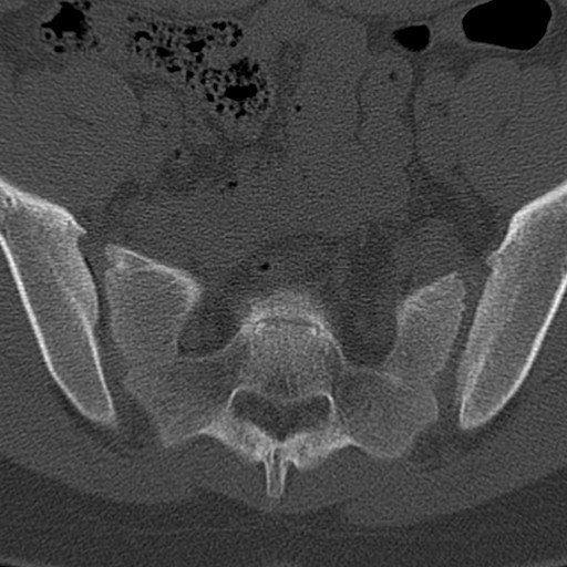 Bilateral pars defect (Radiopaedia 26691-26846 Axial bone window 98).jpg