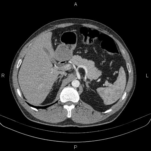 Bilateral pulmonary AVM (Radiopaedia 83134-97505 A 76).jpg
