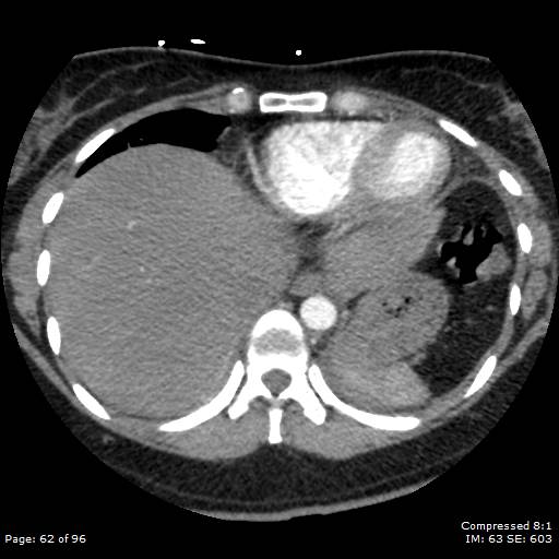 File:Bilateral pulmonary emboli with Hampton hump sign (Radiopaedia 54070-60246 Axial C+ CTPA 59).jpg