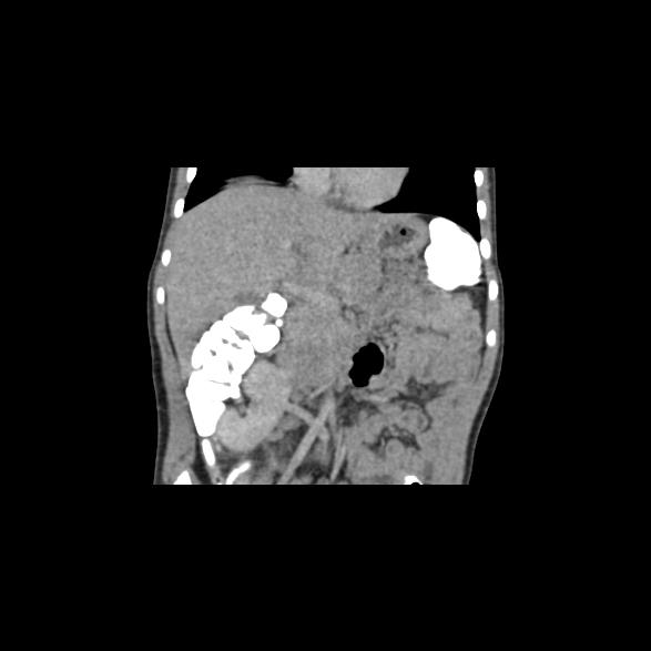 File:Bilateral renal malrotation (Radiopaedia 30901-31606 B 43).jpg