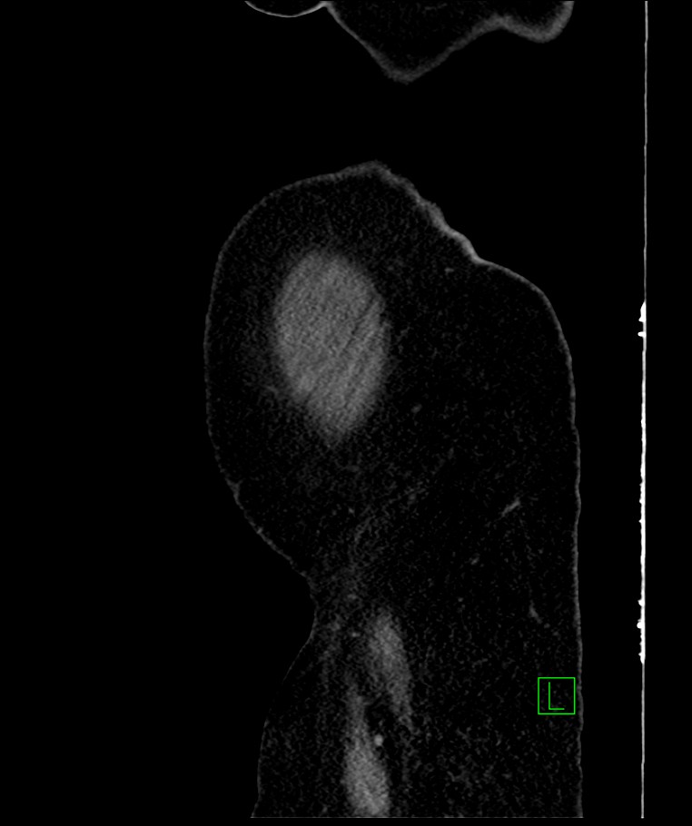 Bilateral sporadic synchronous clear cell renal cell carcinoma (Radiopaedia 85035-100575 E 119).jpg