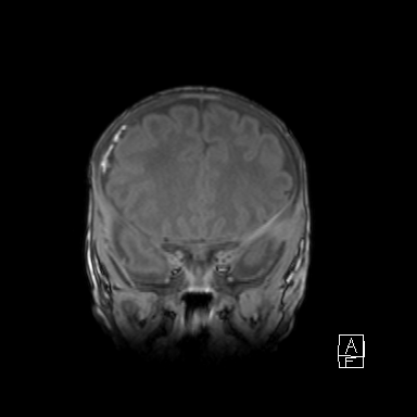 File:Bilateral subdural hemorrhage and parietal skull fracture (Radiopaedia 26058-26190 Coronal T1 16).png