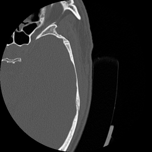 Bilateral temporal bone fractures (Radiopaedia 29482-29970 D 156).jpg