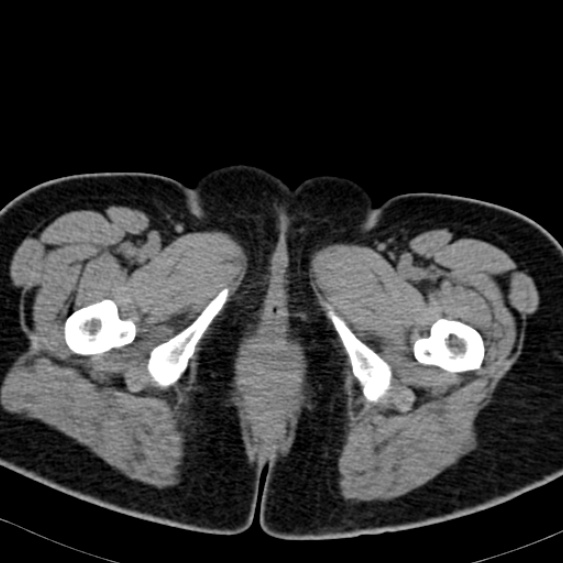Bilateral ureteric stents (Radiopaedia 48795-53825 Axial non-contrast 75).jpg