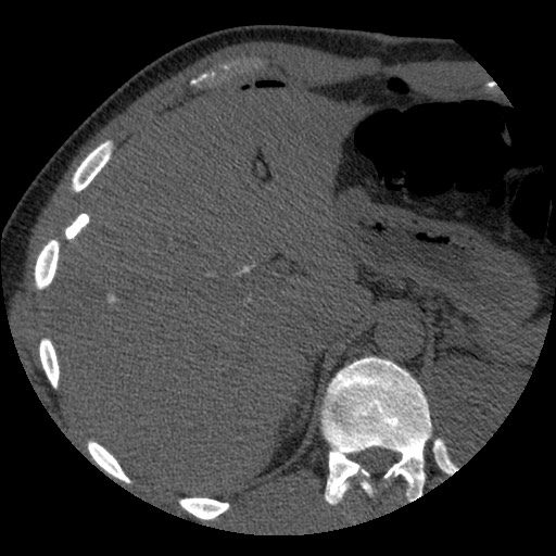 Bile leak from liver traumatic laceration (Radiopaedia 63463-72077 Axial Biliscopin 32).jpg