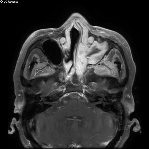 File:Bisphosphonate-related osteonecrosis of the maxilla (Radiopaedia 51367-57101 Axial T1 C+ fat sat 29).jpg