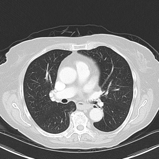 File:Bladder and bowel cancers (Radiopaedia 37688-39592 Axial lung window 26).png