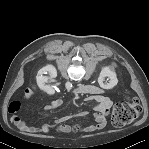 File:Bladder papillary urothelial carcinoma (Radiopaedia 48119-52951 Axial C+ delayed 22).png