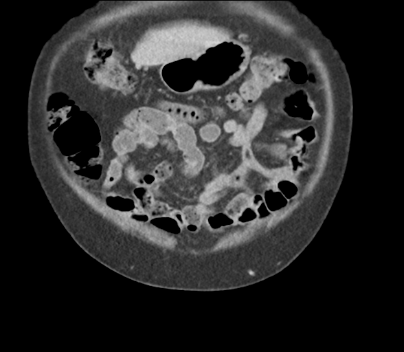 File:Bladder papillary urothelial carcinoma (Radiopaedia 48119-52951 C 13).png