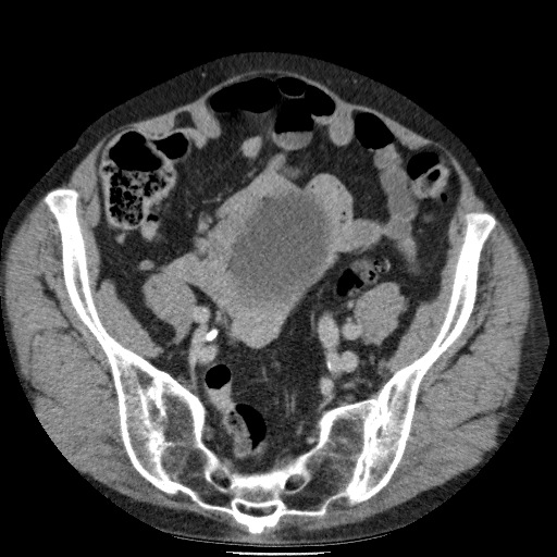 Bladder tumor detected on trauma CT (Radiopaedia 51809-57609 C 104).jpg