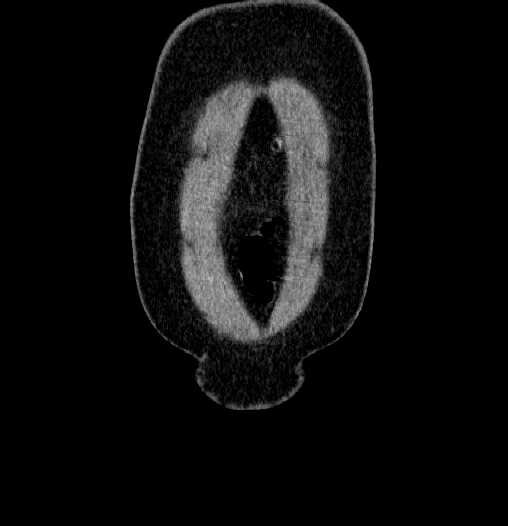 Blind-ending branch of a bifid ureter (Radiopaedia 61159-69048 F 2).jpg