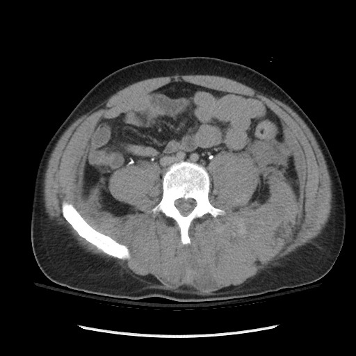 Blunt abdominal trauma with solid organ and musculoskelatal injury with active extravasation (Radiopaedia 68364-77895 Axial C+ delayed 88).jpg