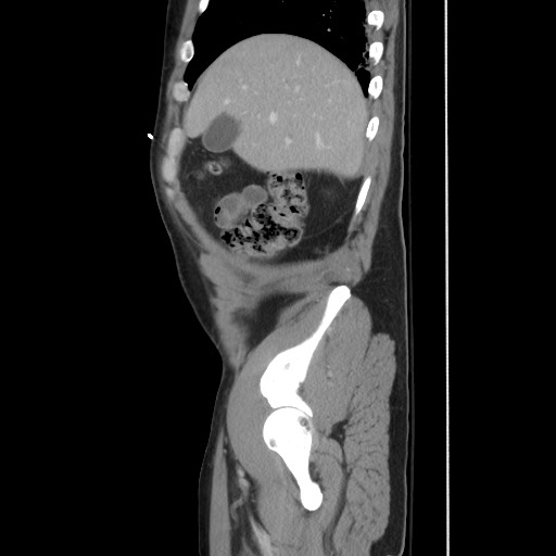 File:Blunt abdominal trauma with solid organ and musculoskelatal injury with active extravasation (Radiopaedia 68364-77895 C 38).jpg