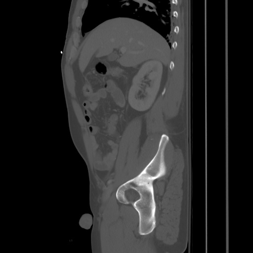 Blunt abdominal trauma with solid organ and musculoskelatal injury with active extravasation (Radiopaedia 68364-77895 Sagittal bone window 27).jpg