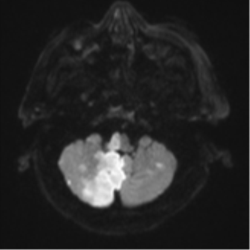 File:Blunt cerebrovascular injury (Radiopaedia 53682-59745 Axial DWI 37).png