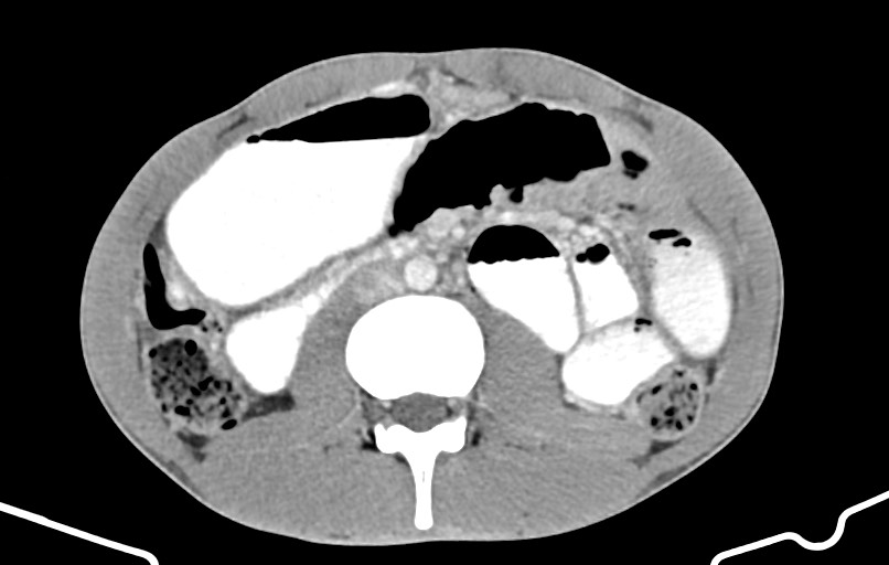 Blunt injury to the small bowel (Radiopaedia 74953-85987 A 85).jpg