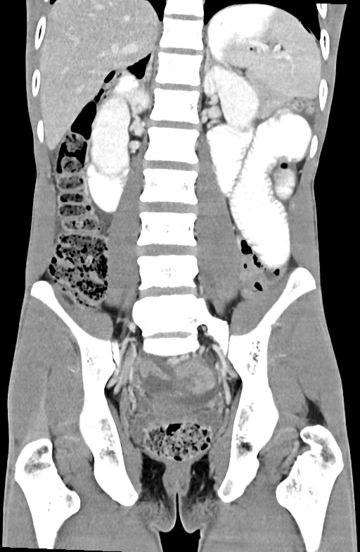 Blunt injury to the small bowel (Radiopaedia 74953-85987 B 62).jpg