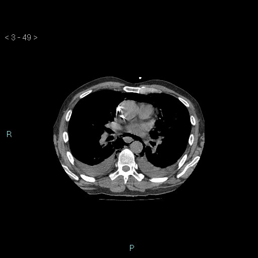 Boerhaave syndrome (Radiopaedia 27683-27897 Axial non-contrast 49).jpg
