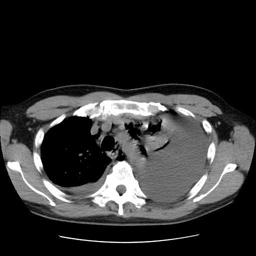Boerhaave syndrome (Radiopaedia 59796-67310 Axial liver window 20).jpg