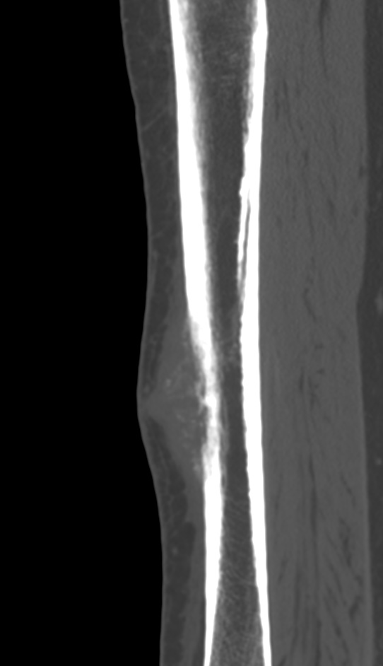 Bone metastasis - tibia (Radiopaedia 57665-64609 Sagittal bone window 75).jpg