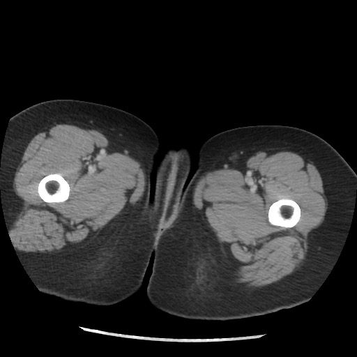 File:Borderline mucinous tumor (ovary) (Radiopaedia 78228-90808 A 150).jpg