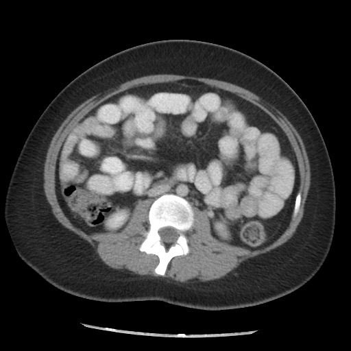 File:Borderline mucinous tumor (ovary) (Radiopaedia 78228-90808 A 91).jpg