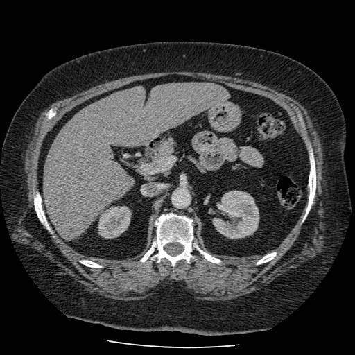 Bovine aortic arch - right internal mammary vein drains into the superior vena cava (Radiopaedia 63296-71875 A 199).jpg