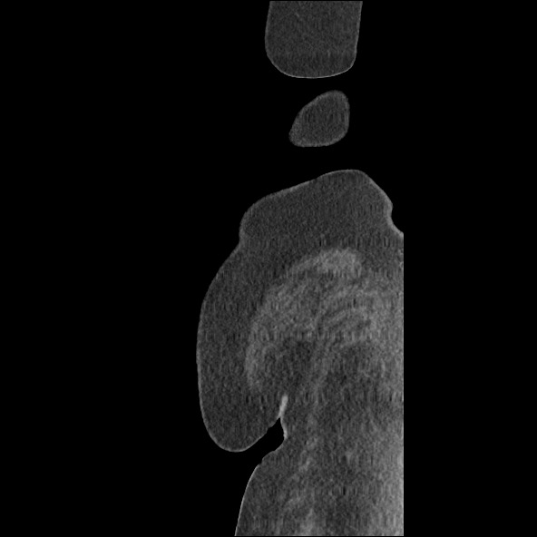 Bowel and splenic infarcts in acute lymphocytic leukemia (Radiopaedia 61055-68915 C 1).jpg