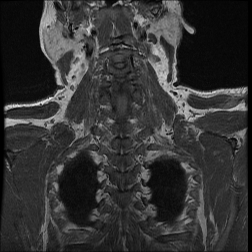 File:Brachial plexus neurofibroma (Radiopaedia 28030-28291 Coronal T1 2).png