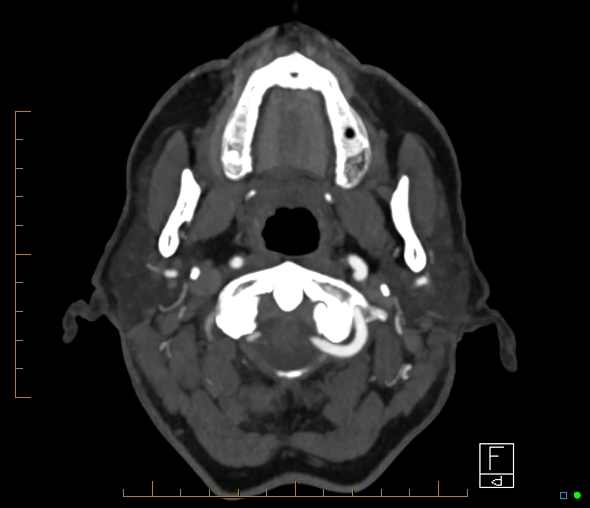 Brachiocephalic trunk stenosis (Radiopaedia 87242-103519 A 68).jpg