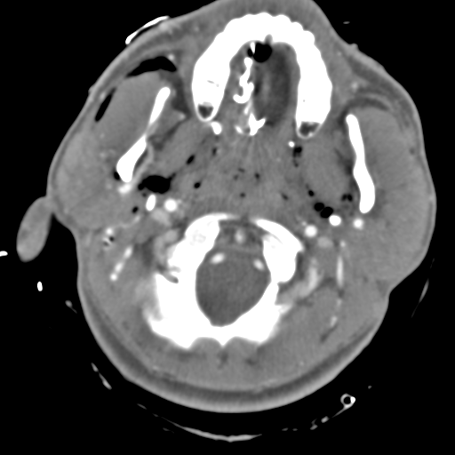 Brain contusions, internal carotid artery dissection and base of skull fracture (Radiopaedia 34089-35339 D 52).png