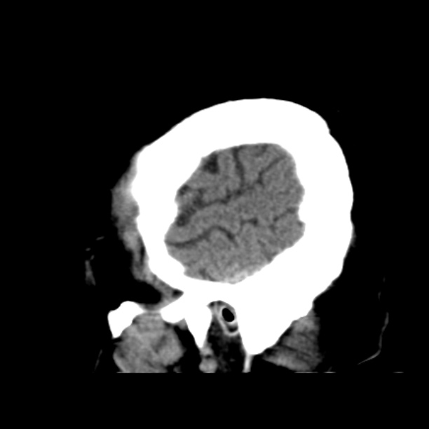 Brain cortical laminar necrosis (Radiopaedia 25822-25971 non-contrast 7).jpg