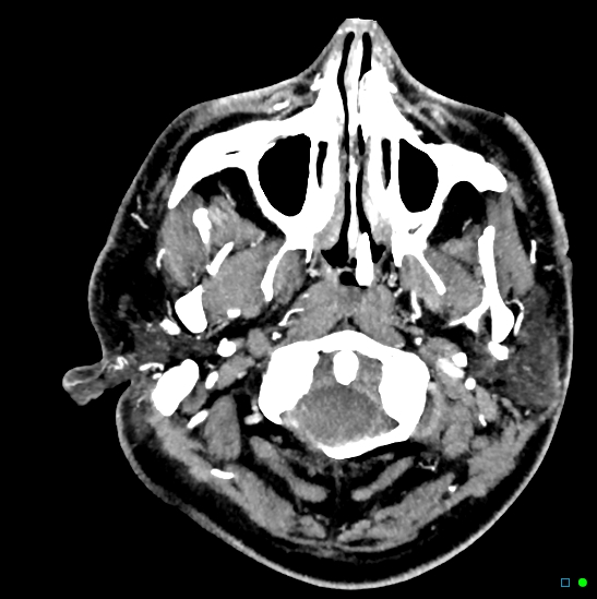 Brain death on MRI and CT angiography (Radiopaedia 42560-45841 B 50).jpg