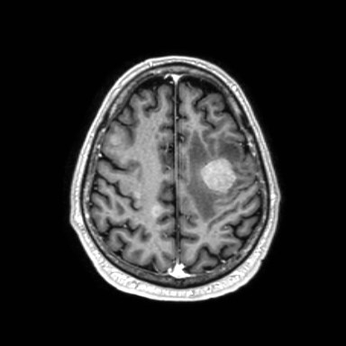 Brain metastases from lung cancer (Radiopaedia 83839-99028 Axial T1 C+ 52).jpg