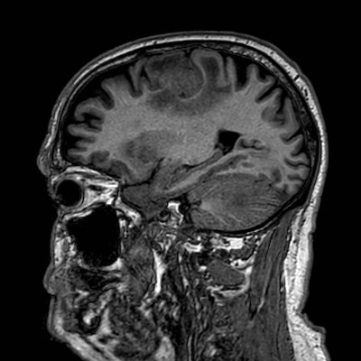 Brain metastases from lung cancer (Radiopaedia 83839-99028 Sagittal T1 87).jpg