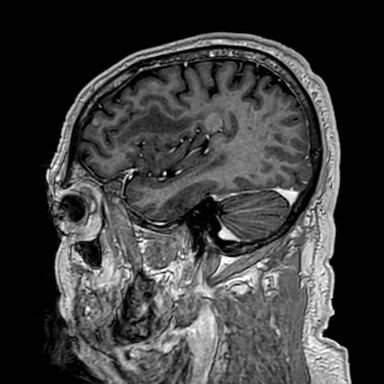 Brain metastases from lung cancer (Radiopaedia 83839-99028 Sagittal T1 C+ 13).jpg