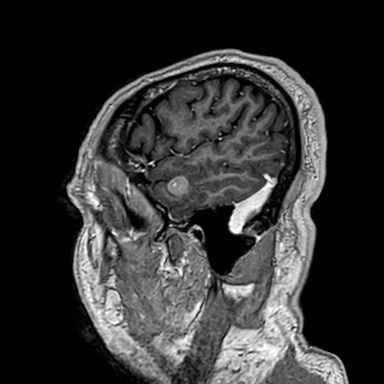 Brain metastases from lung cancer (Radiopaedia 83839-99028 Sagittal T1 C+ 57).jpg