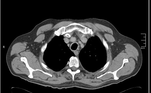 File:Brain metastases from squamocellular lung cancer (Radiopaedia 56515-63219 B 16).jpg