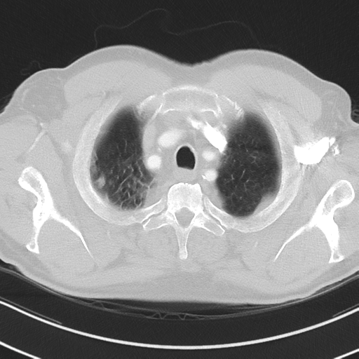Brain metastasis (large cystic mass) (Radiopaedia 47497-52104 Axial lung window 5).png