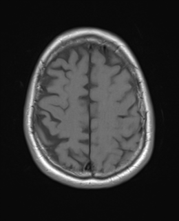 File:Brain metastasis (large cystic mass) (Radiopaedia 47497-52107 Axial T1 22).png