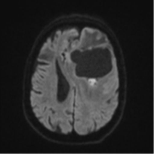 Brain metastasis (lung cancer) (Radiopaedia 48289-53179 Axial DWI 47).png