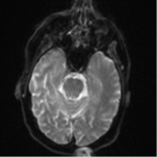 File:Brain metastasis (lung cancer) (Radiopaedia 48289-53179 Axial DWI 9).png