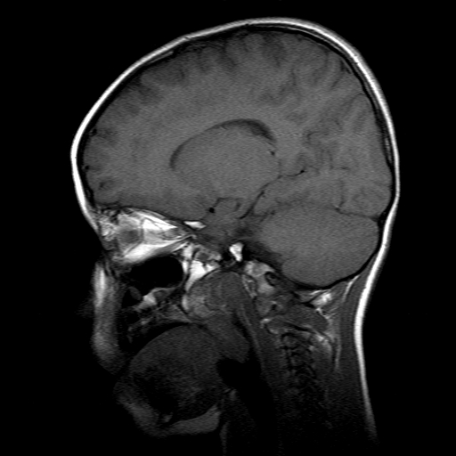 File:Brainstem ganglioglioma (Radiopaedia 10763-11224 Sagittal T1 8).jpg