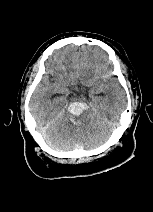 Brainstem hemorrhage (Radiopaedia 81294-94976 Axial non-contrast 41).jpg