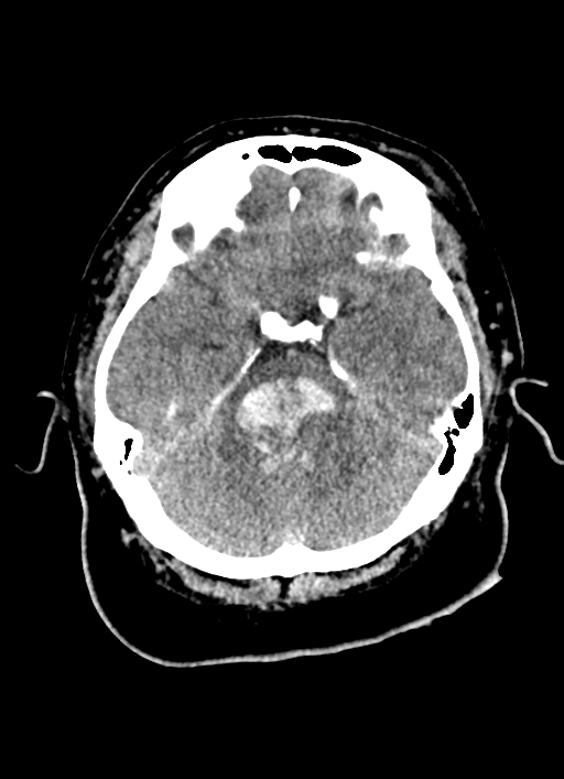 Brainstem hemorrhage (Radiopaedia 81294-94976 Axial non-contrast 43).jpg